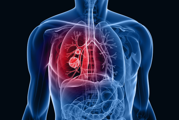 폐 선암 원인 유전자 발굴